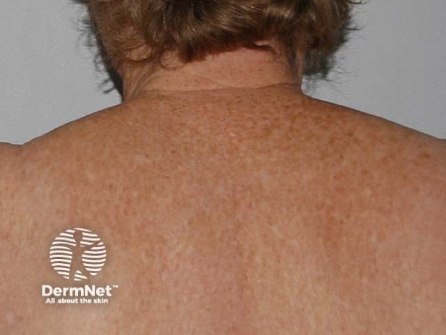 Fair skin and red hair