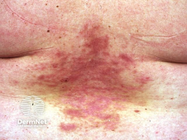 Darier disease after acitretin