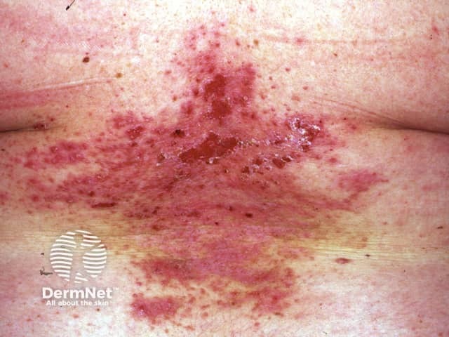 Darier disease before acitretin