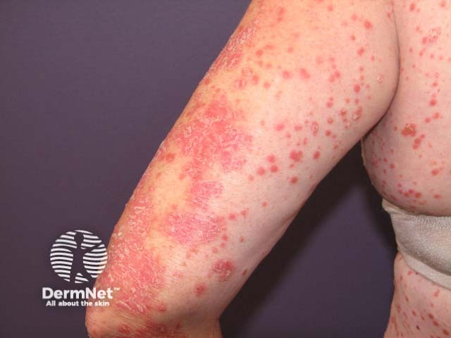 Guttate psoriasis