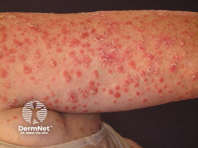 Guttate psoriasis
