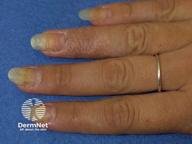Nails in psoriasis