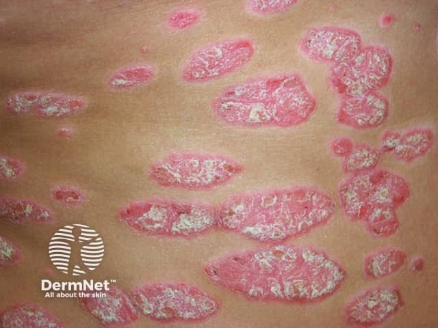 Chronic plaque psoriasis; topical treatment options would include tapinarof cream