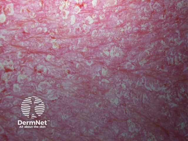 Erythrodermic psoriasis