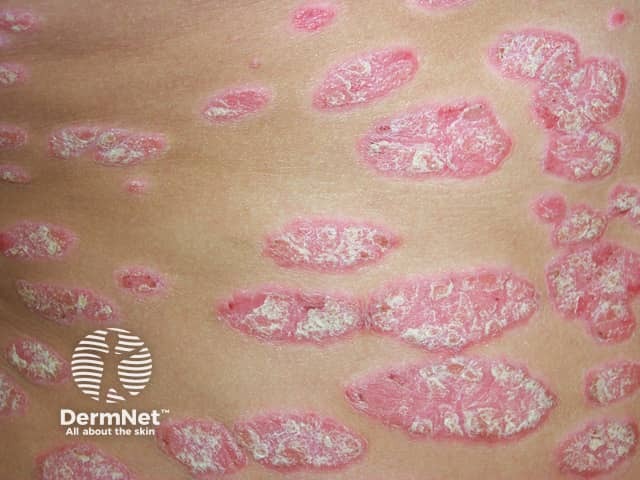 Plaque psoriasis