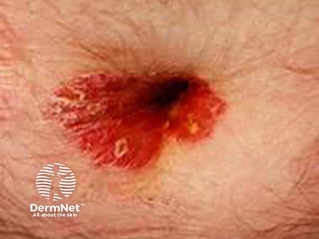 Umbilical psoriasis