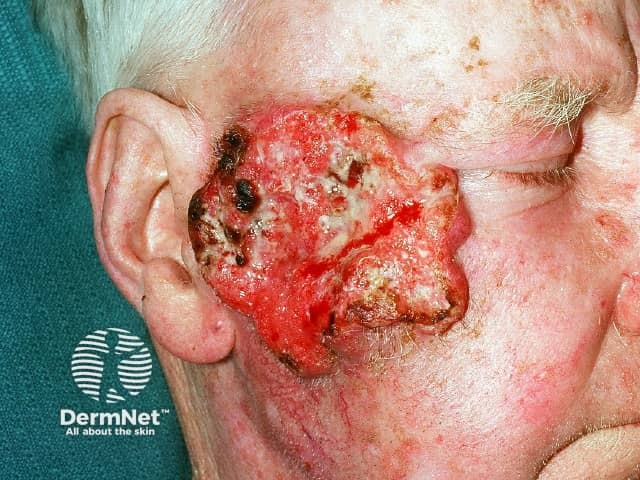 Advanced squamous cell carcinoma