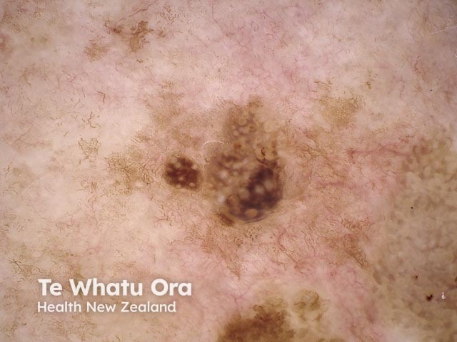 Seborrhoeic keratosis, polarised dermoscopy view