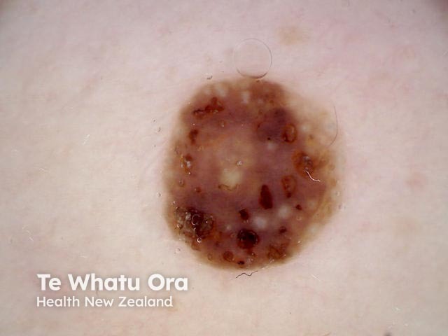 Seborrhoeic keratosis, polarised dermoscopy view