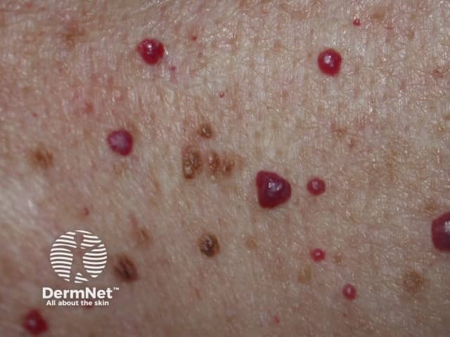 Cherry angiomas