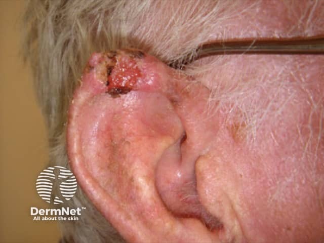 Poorly-differentiated squamous cell carcinoma