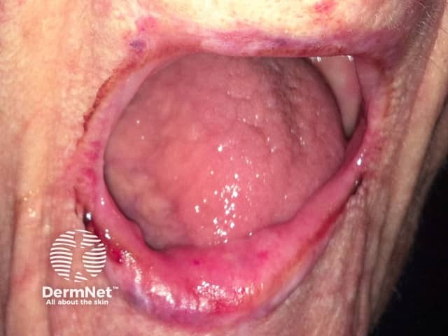 Eosinophilic ulcer of the lip