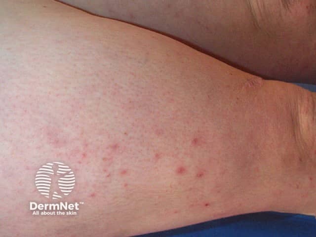 Prurigo of pregnancy