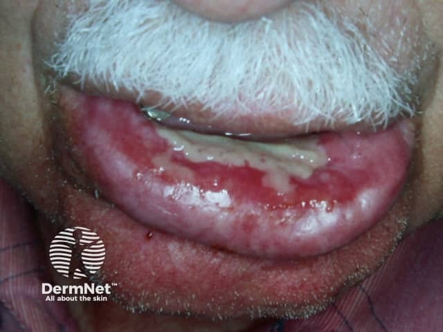 Radiation stomatitis