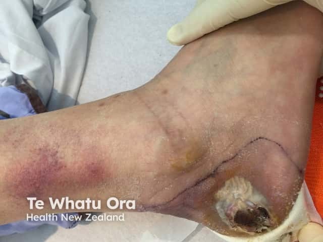 Diabetic ulcer