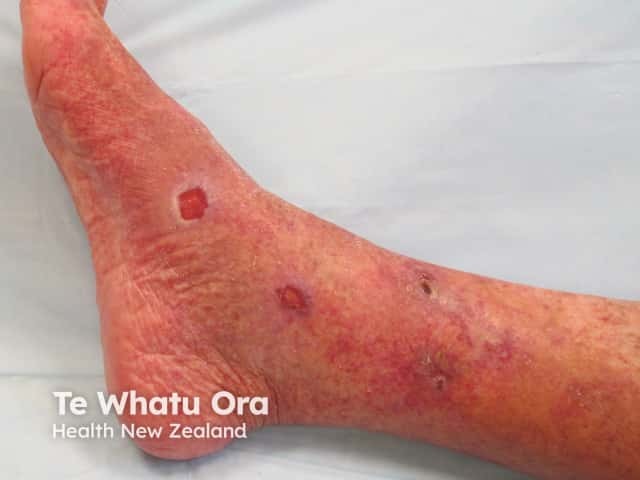 Livedoid vasculopathy