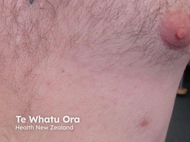 supernumerary nipple