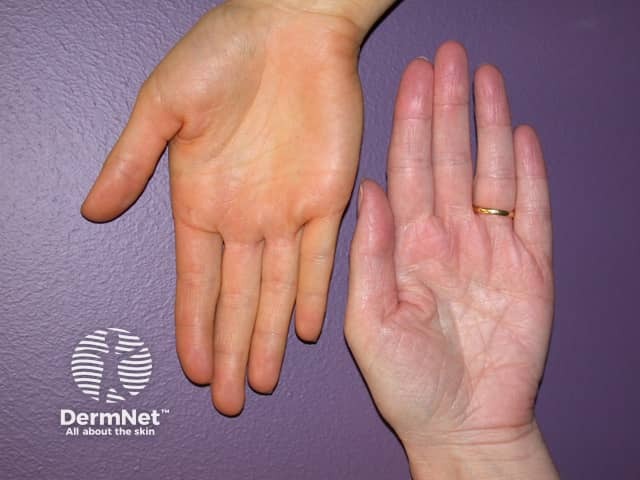 Normal palm colour and carotenoderma