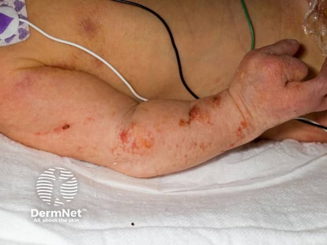 Focal dermal hypoplasia (Goltz syndrome)