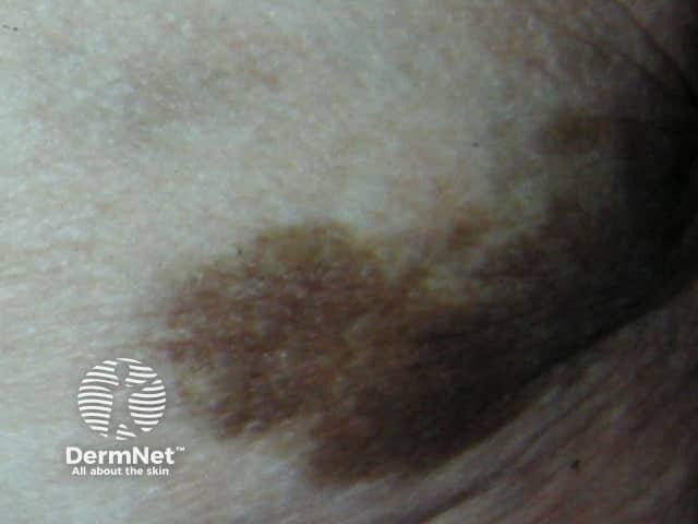 Intramuscular, close-up