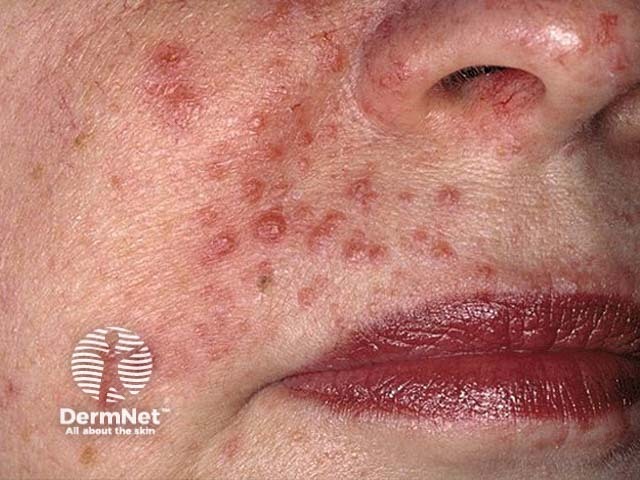 Angiofibromas in tuberous sclerosis