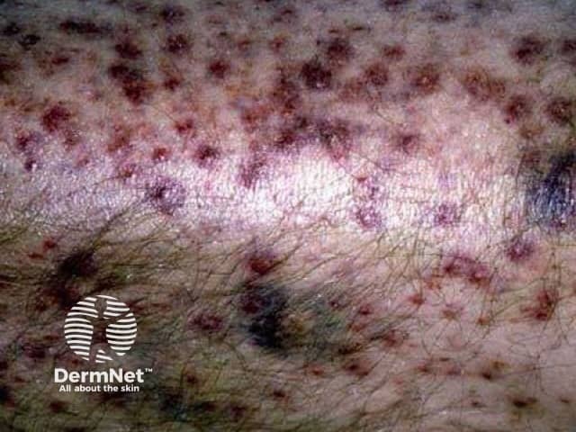 Perifollicular haemorrhage and ecchymoses