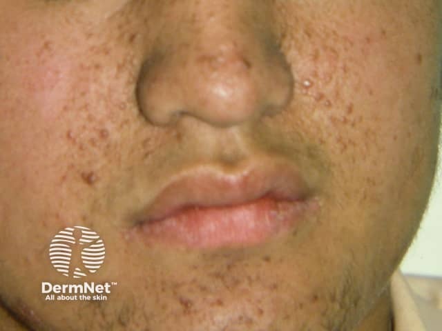 Angiofibromas in tuberous sclerosis