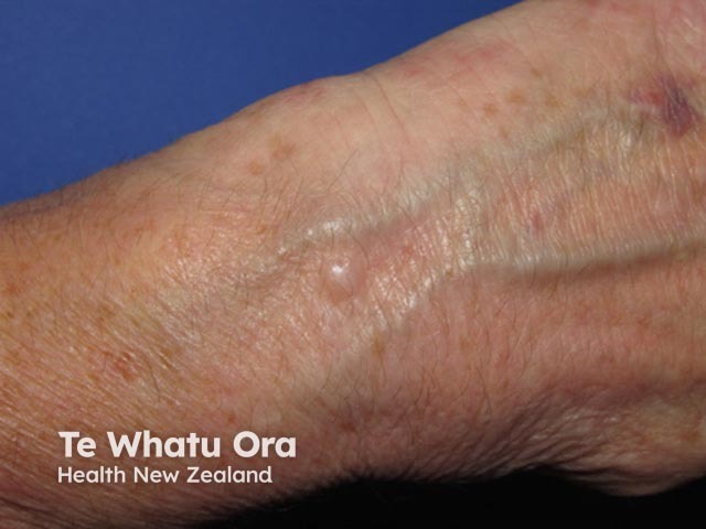 Cutaneous myxoma