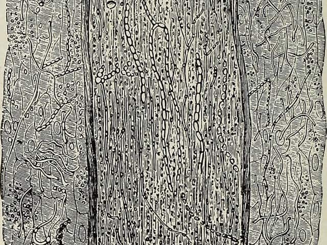 Endothrix invasion of a hair shaft by Trichophyton tonsurans
