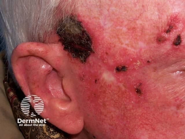 Imiquimod to actinic keratosis