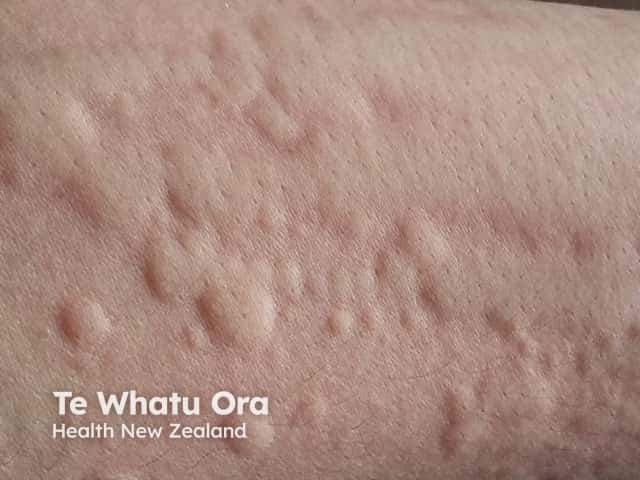 demographic urticaria