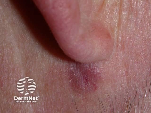 A plaque of granuloma faciale under the lobe of the ear