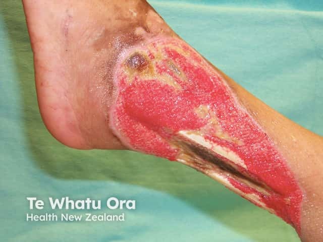 Cutaneous polyarteritis nodosa