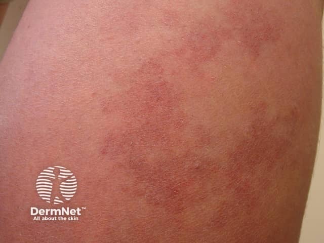 Vascular malformation