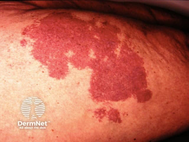 Vascular malformation