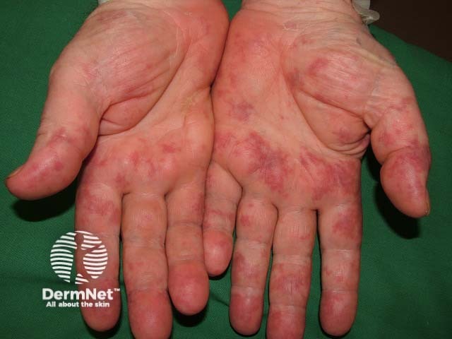 Vasculitis due to cryoglobulinaemia
