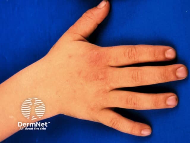 Gianotti-Crosti syndrome