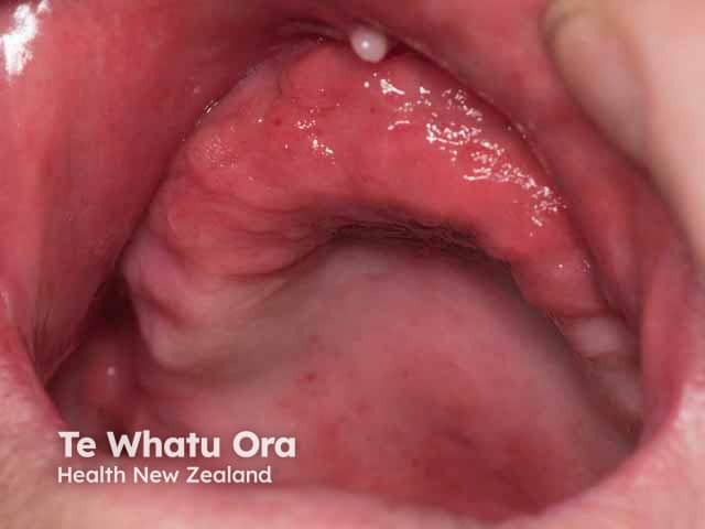 Epulis fissuratum, upper maxilla