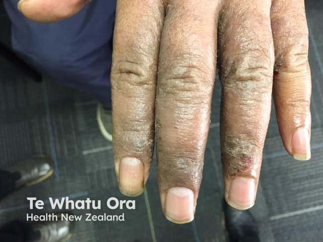 Thickening, dryness, and scale on the dorsal fingers