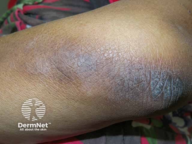 Acanthosis nigricans on the elbow