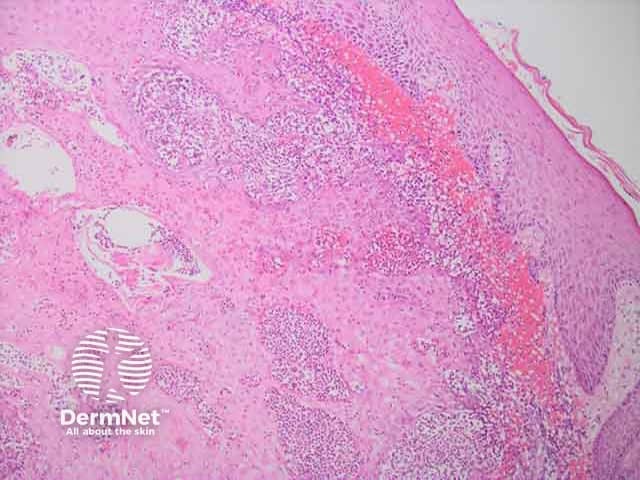 Upper dermal neutrophilic infilltrate in cutaneous myeloid sarcoma H and E histopathology