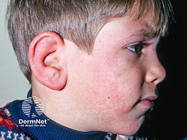 Allergic contact dermatitis due to allergy to a constituent in an ear drop