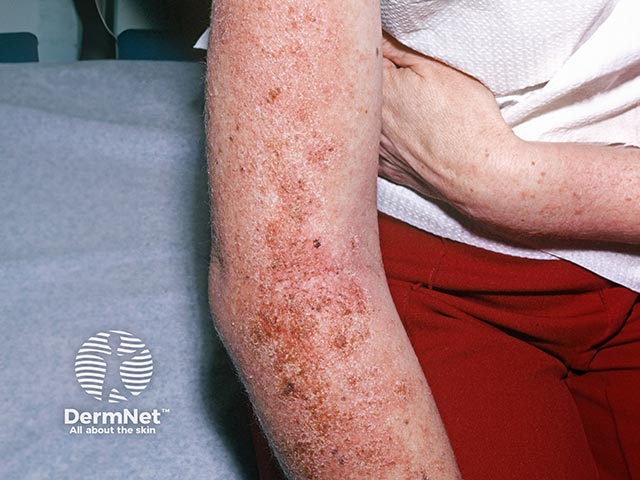 An exudative allergic contact dermatitis on the arm