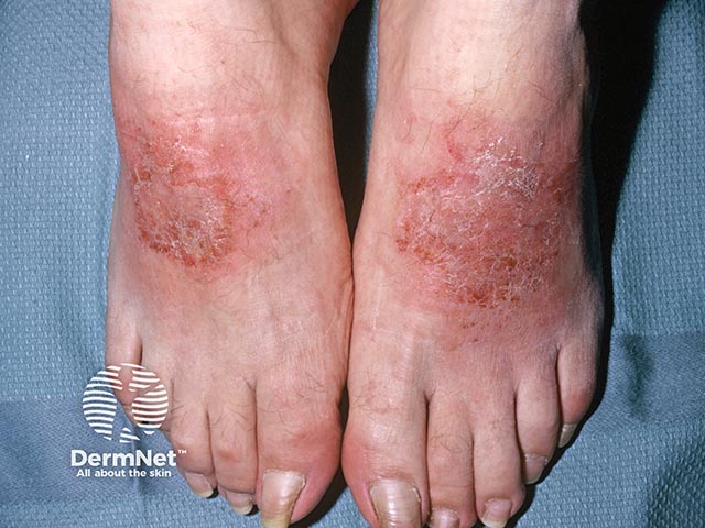 Contact dermatitis due to a sandal strap