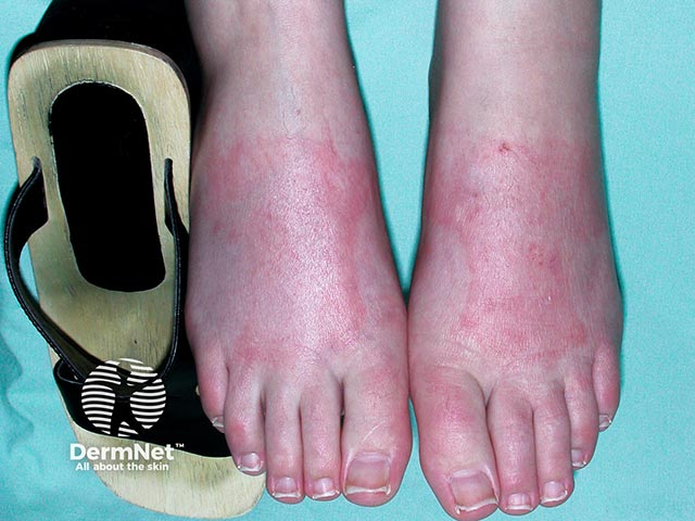 Contact allergy to a sandal strap