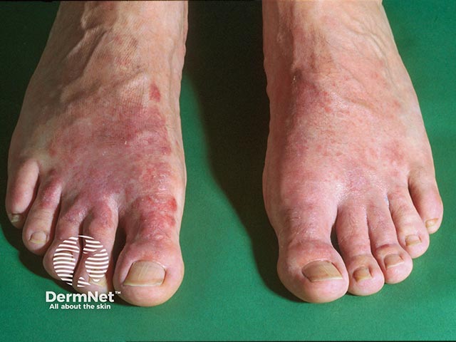 Footwear allergy - note the sparing between the toes