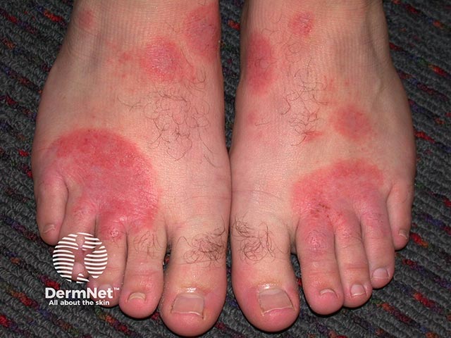 Allergic contact dermatitis due to a shoe constituent
