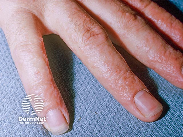 An id reaction on the hands due to a shoe constituent reaction on the feet