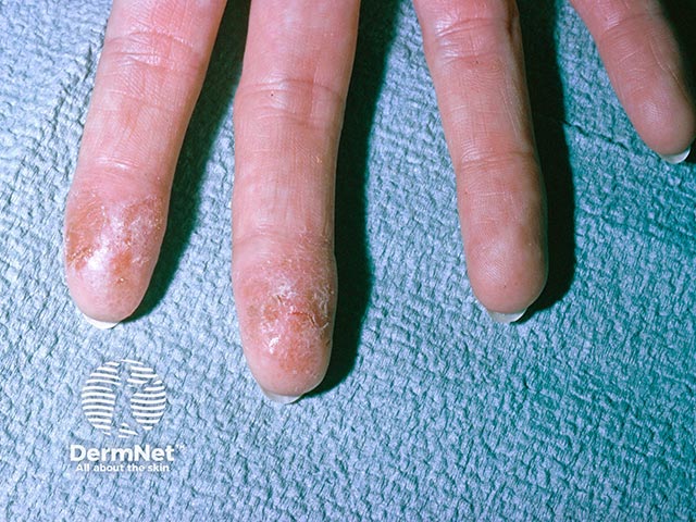 Contact allergy to an acrylate on the finger pulps