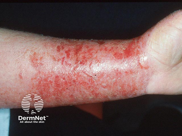 Acute allergic contact dermatitis from a rubber glove - note the cut-off midway down the forearm